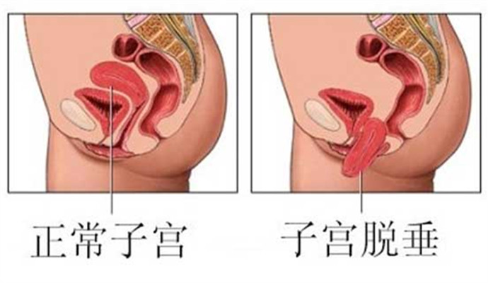 正常子宫vs产后子宫