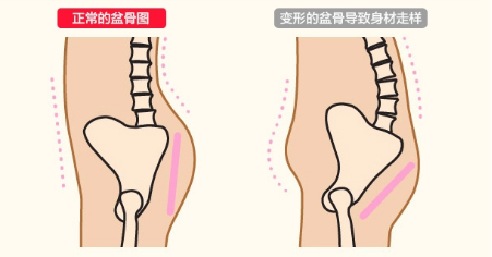 正常盆底肌VS产后盆底肌